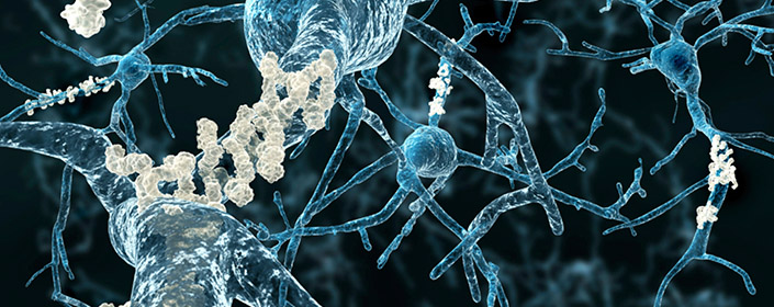 alzheimers amyloid plaques