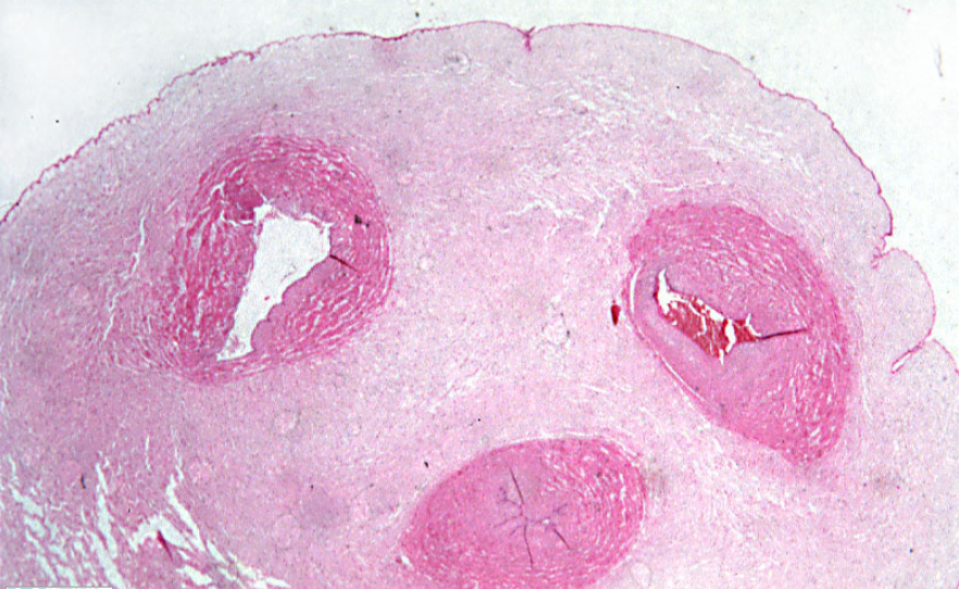 Wharton's Jelly Derived Mesenchymal Stem Cells  Stemedix