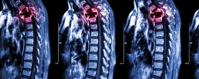 Autologous mesenchymal stromal cell transplantation for spinal cord injury