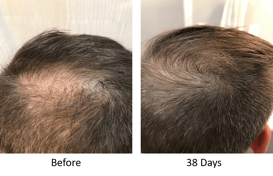 Stem Cell Therapy For Hair Loss | Stemedix | Regenerative Medicine Also  Known As Stem Cell Therapy | Stem Cell Treatment