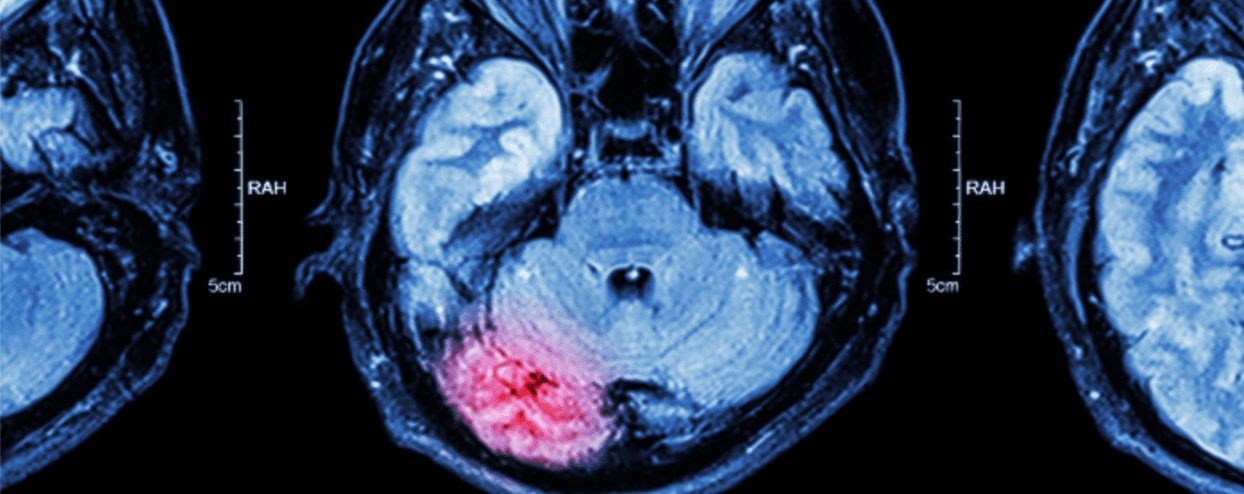 Do Brain Injuries Worsen Over Time?