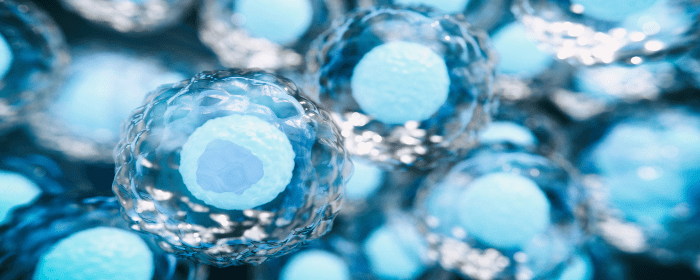 The Benefits of Autologous Mesenchymal Stem Cell Transplant in Active Progressive Multiple Sclerosis