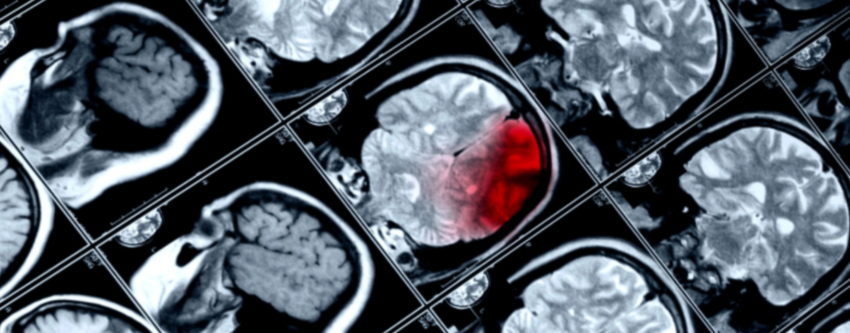 What Are Examples of TBI? | Stemedix | Regenerative Medicine