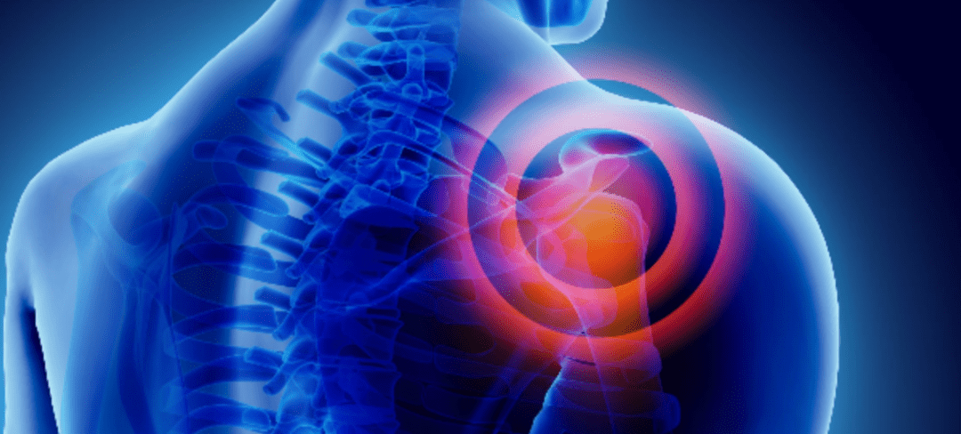 What Is Shoulder Impingement Syndrome?