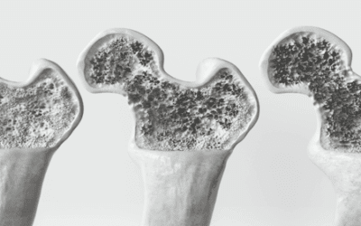 Stem Cell Therapy for Osteoporosis: Exploring the Future of Bone Health