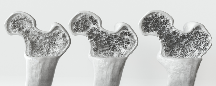 Stem Cell Therapy for Osteoporosis: Exploring the Future of Bone Health