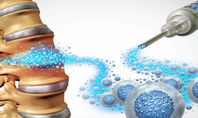 How Stem Cells Help Manage Chronic Pain in Spinal Cord Injury Patients