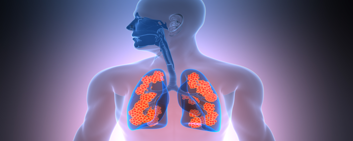 Innovations in Pulmonary Care: How MSCs Could Transform IPF Treatment