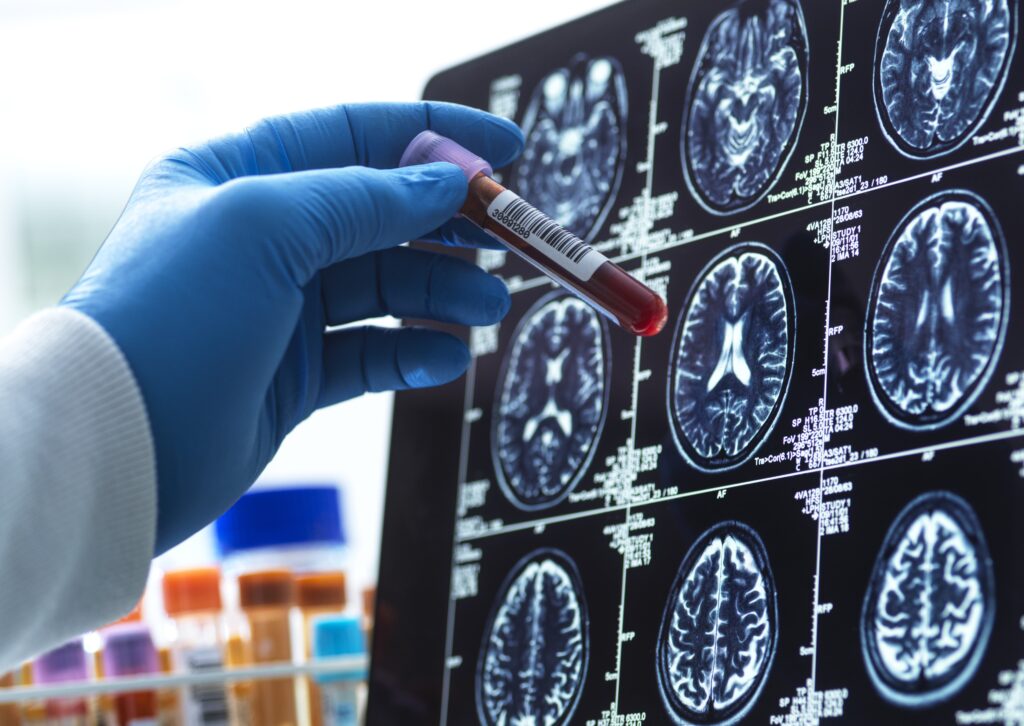 Gloved hand holding a blood sample vial in front of brain MRI scans for neurological testing.