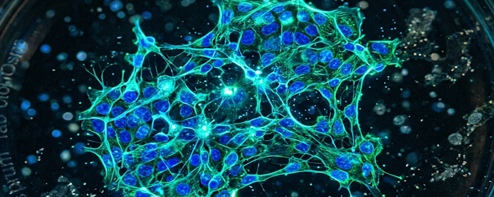 CRISPR-Edited Stem Cells and Sickle Cell Disease: A New Approach to Preventing Pain Crises